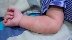 করোনার প্রভাবে সৃষ্ট রোগে লস এঞ্জেলেসে ১ শিশুর মৃত্যু