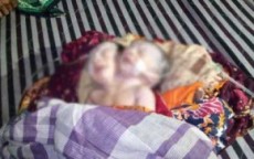 বাংলাদেশে ২ মাথার শিশুর জন্ম