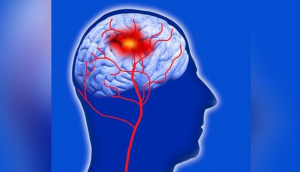 জেনে নিন স্ট্রোকের অস্বাভাবিক লক্ষণগুলো